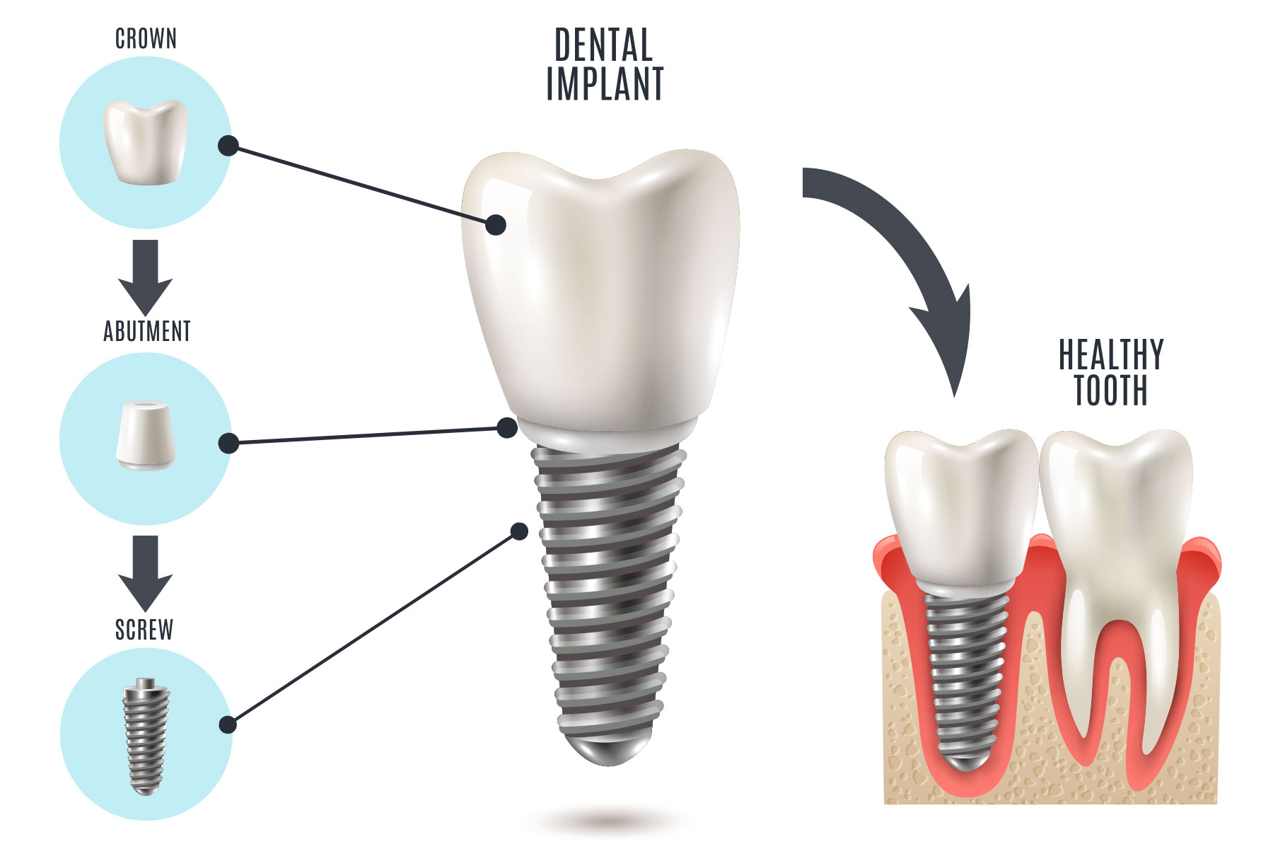 Implants – KH Dental